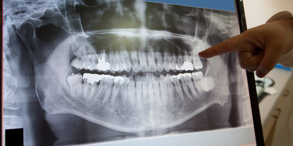 Periodontal Disease and Breast Cancer